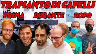 TRAPIANTO DI CAPELLI  - AUTOTRAPIANTO CON TECNICA FUE IN ITALIA, VI SVELIAMO LA NOSTRA ESPERIENZA