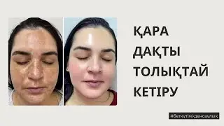 ҚАРА ДАҚ КЕТІРУ | қара дақты кетірудің 3 жолы | пигментные пятна #пигментныепятна #пигментация