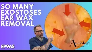 WHAT ARE THESE LUMPS IN THIS EAR CANAL? -  EAR WAX REMOVAL - EP965