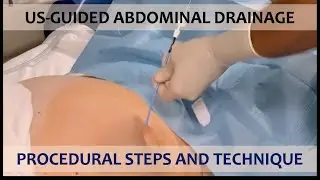 Percutaneous abdominal drainage under ultrasound guidance: procedural steps and technique