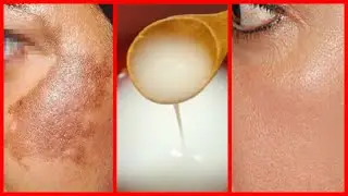 REJUVENESCE E TIRA MANCHAS EM POUCO TEMPO DEIXANDO A PELE BRILHANTE E CLARINHA