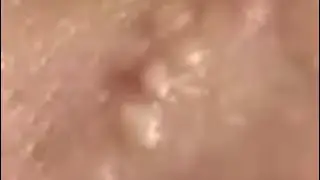 Dr. Marlon's Enormous Pimple Pops