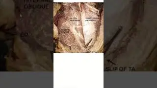 Rectus abdominis muscle 