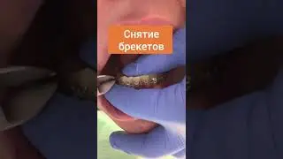 Removal of braces