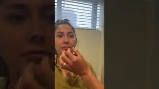 Rhinoplasty 7 months post-op | Anthony Bared MD, FACS | Miami, FL