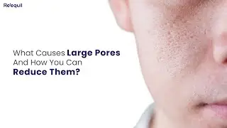 What Causes Large Pores And How You Can Reduce Them?