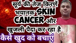 sun allergy treatment || Solar Urticaria treatment with homeopathic medicines