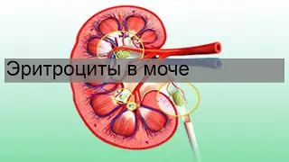 Эритроциты в моче