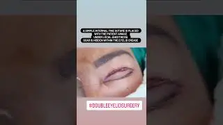 Double Eyelid Surgery | Blepharoplasty | Upper eyelid surgery | Asian eyelid surgery 