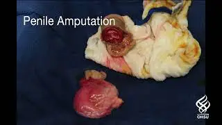 Core Videos (2021): Penile Replantation Surgical Technique and Management
