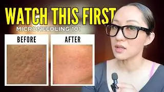 Microneedling Basics: What You ACTUALLY Need To Know (Start Here)
