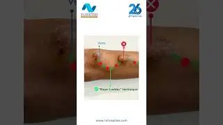 Small Changes in AVF Needling, Big Difference in Safety | Rope Ladder Technique | Dr Krishna Prasad