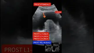 Ultrasound showing Enlarged prostate:prostatomegaly 