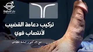 تركيب دعامة القضيب لأنتصاب قوي \ مع الدكتور اسامة غطاس
