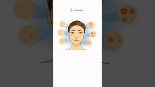 🔹Yuzingizga toshmalar toshishi ko’p holatlarda iste’mol qilayotgan mahsulotlaringizga bog’liq…