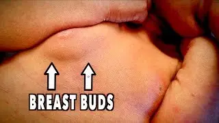 BABY BOY with BREAST BUDS | Dr. Paul