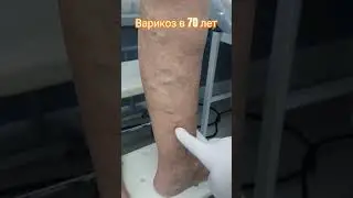 Варикоз в пожилом возрасте. 