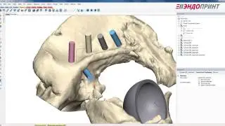 Реконструкция вертлужной впадины индивидуальным имплантом. Pacient Specific Acetabular Cup
