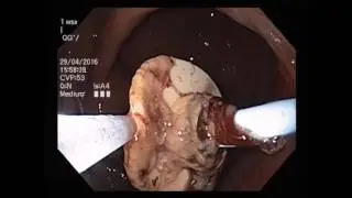 Buried bumper syndrome with bleeding and hemostasis