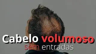 COMO ACABAR ou PREVENIR A CALVÍCIE/ENTRADAS | CABELO MASCULINO | GLOW UP 2023
