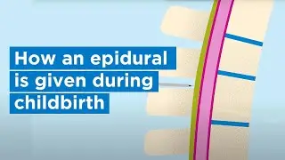 How an epidural is given during childbirth | Bupa Health