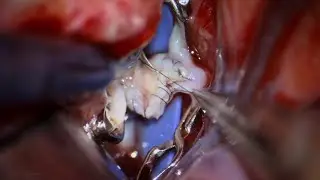 Superficial Temporal Artery to M2 MCA Bypass for Supraclinoid Internal Carotid Artery Occlusion