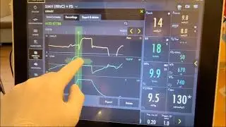 Servo U   Insp and Exp Holds and Pocc Maneuver