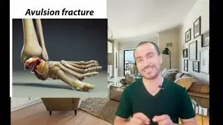 Types of bone Fractures.#education #viralvideo