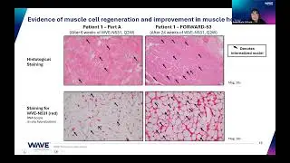 CureDuchenne Webinar with Wave Life Sciences | Interim Results