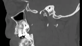 Periapical Cemento Osseous Dysplasia