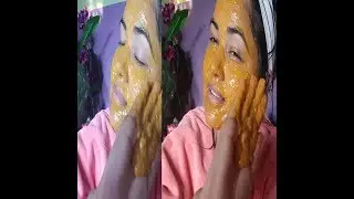 बर्सौ पुरानो चायापोतो पनि 7 दिनमा गायब बनाउने अचुक घरेलु उपाय  old pigmentation melasma remove 7 day