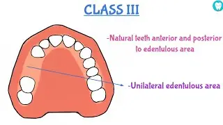 Kennedy's Classification and Applegate's Rule (Easily Explained)