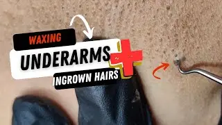 Underarm wax & Blackhead!