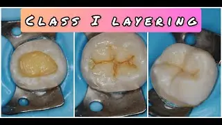 💯Detailed class I resin composite restoration layering technique! Made Simple!
