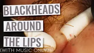 Deep Blackheads Around The Lips with Gebhard (Re-upload with music only)