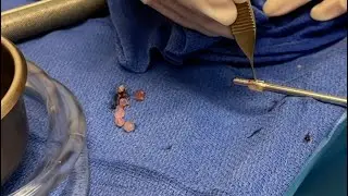 SHE WAS INJECTED ILLEGAL FILLERS IN HER VAGINA | SILICONE INJECTION | LABIA MAJORA | DR. MATLOCK