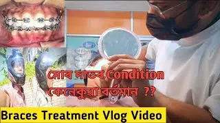 Braces treatment vlog video||মোৰ জাতৰ condition 🙂