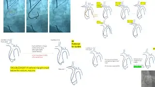 Left EBU/CLS guides manipulations, radial and femoral +Ikari L +Key tips in left coronary engagement