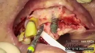 Dr. Alex Fibishenko - Pikos Symposium 2023 - Failed Implant Removal with Full Arch Restoration