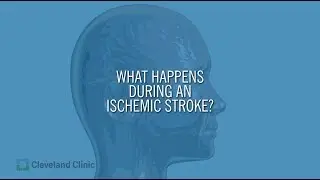 What Happens During an Ischemic Stroke