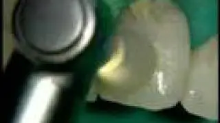 Dentsply - Pogo One step diamond micro-polisher