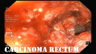 carcinoma rectum| sigmoidoscopy| Dr. Pandiaraja