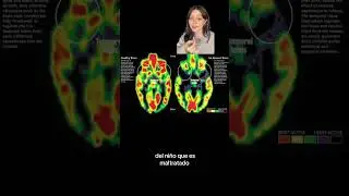 ¿Cómo afecta el trauma al desarrollo cerebral en la infancia? 🧠 | #neurociencias #trauma