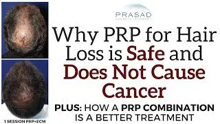 Why PRP for Hair Loss is Safe and Will Not Cause Cancer, but a PRP Combination is a Better Treatment