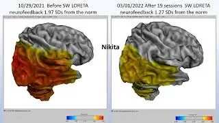 QEEG and Neurofeedback in the Assessment and Treatment of Concussion. Anthony Silver SBMT March 2022