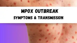 Mpox (Monkeypox) Virus Origins, Transmission & Symptoms To Look Out For