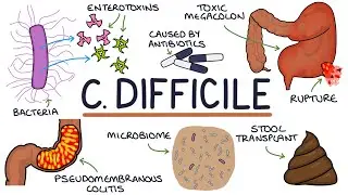 Understanding Clostridium Difficile Infection (C. Diff)