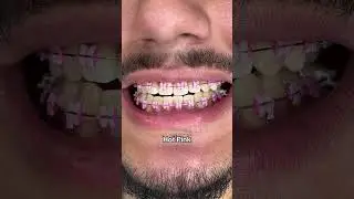 Braces Colors that make your teeth look Whiter