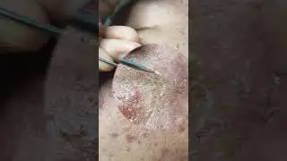 Best Satifying videos for Relaxation with Rat Tana Acne Spa =Short