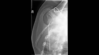 Laying the scapula